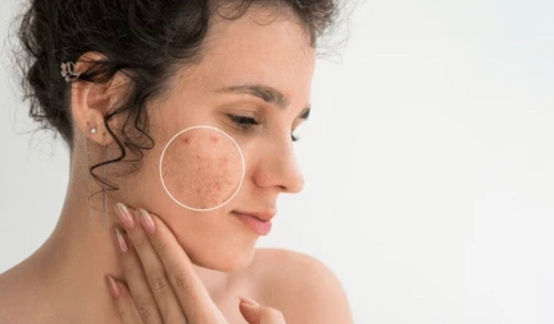 Acné / imperfections